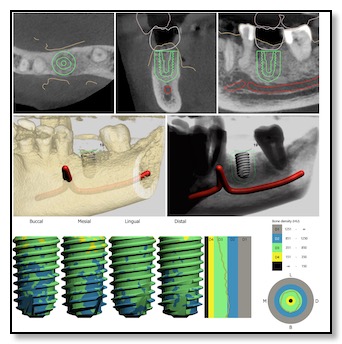 Surgical Guide Design for implant placement