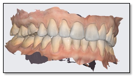 optical scan to make abutment and crown